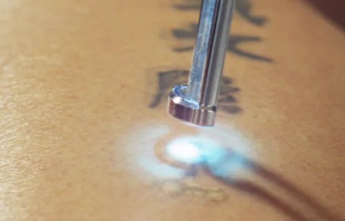 essex-mens-tattoo-removal
